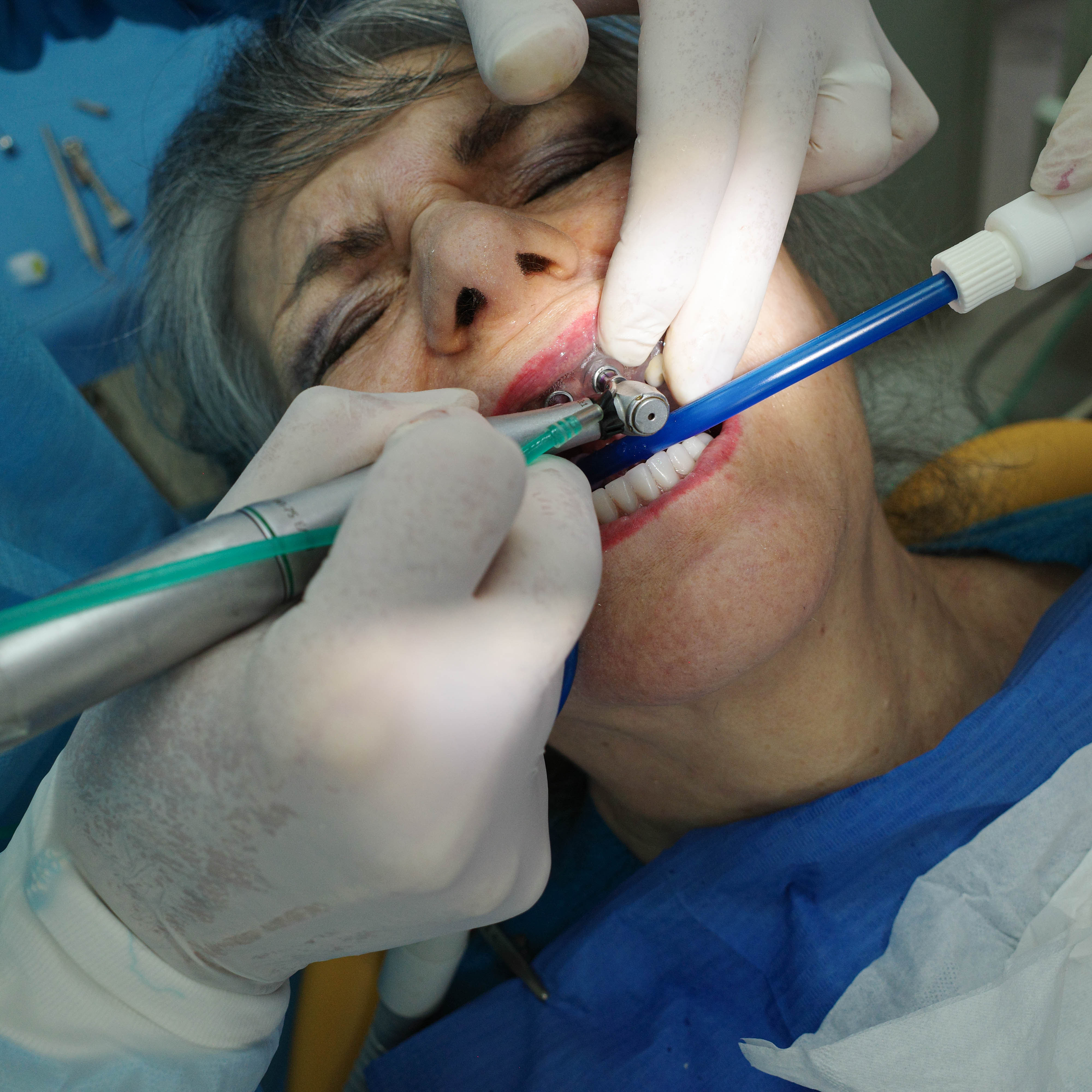 Impianti dentali in centro a Milano