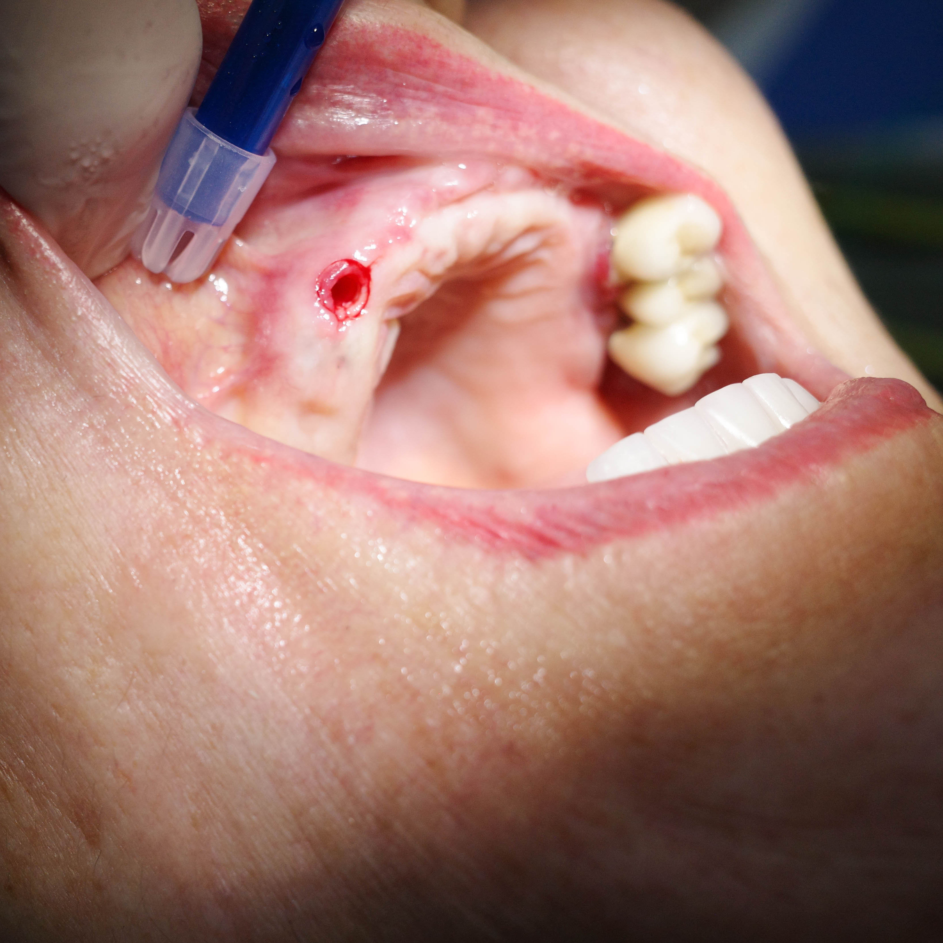 Impianti dentali in centro a Milano