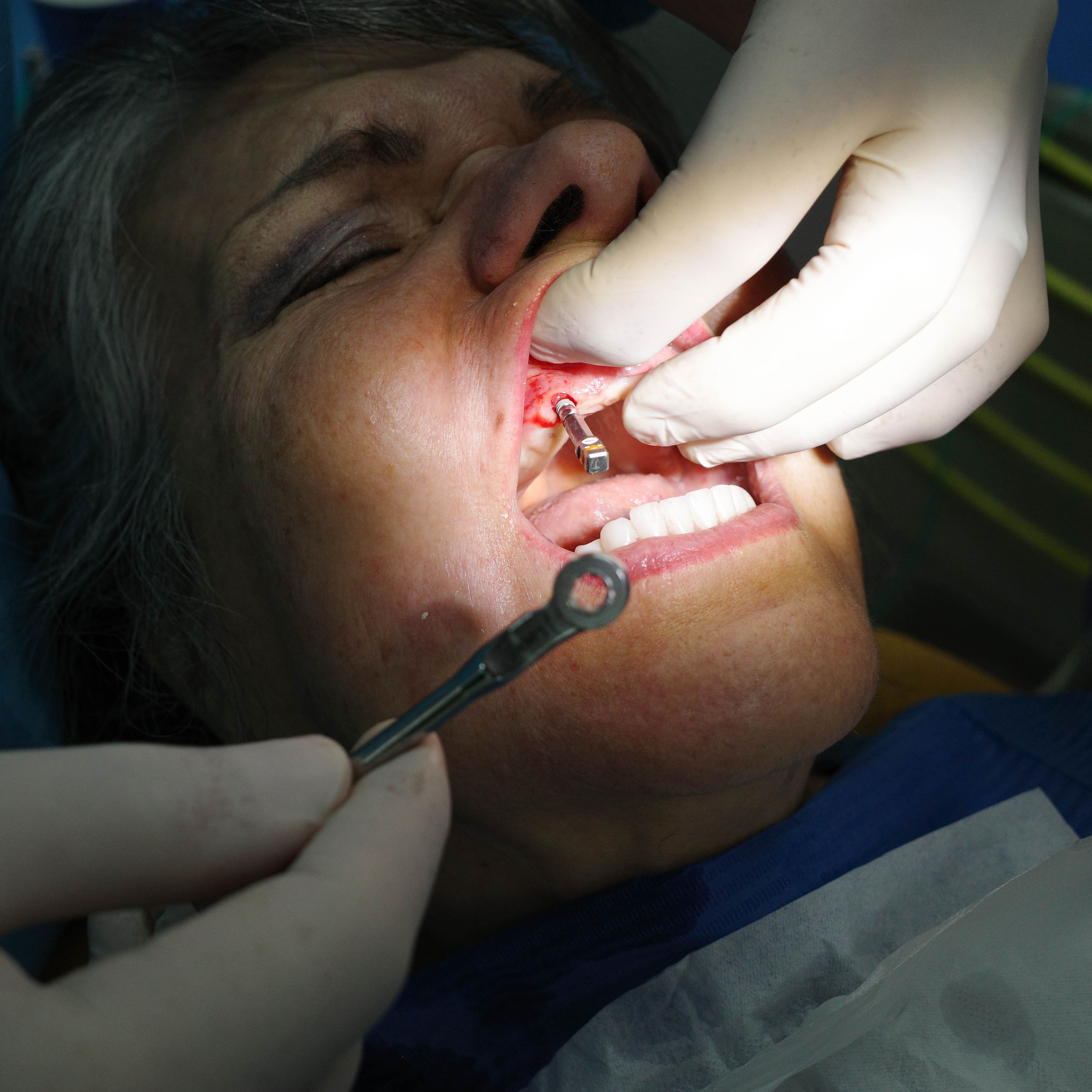 Impianti dentali in centro a Milano