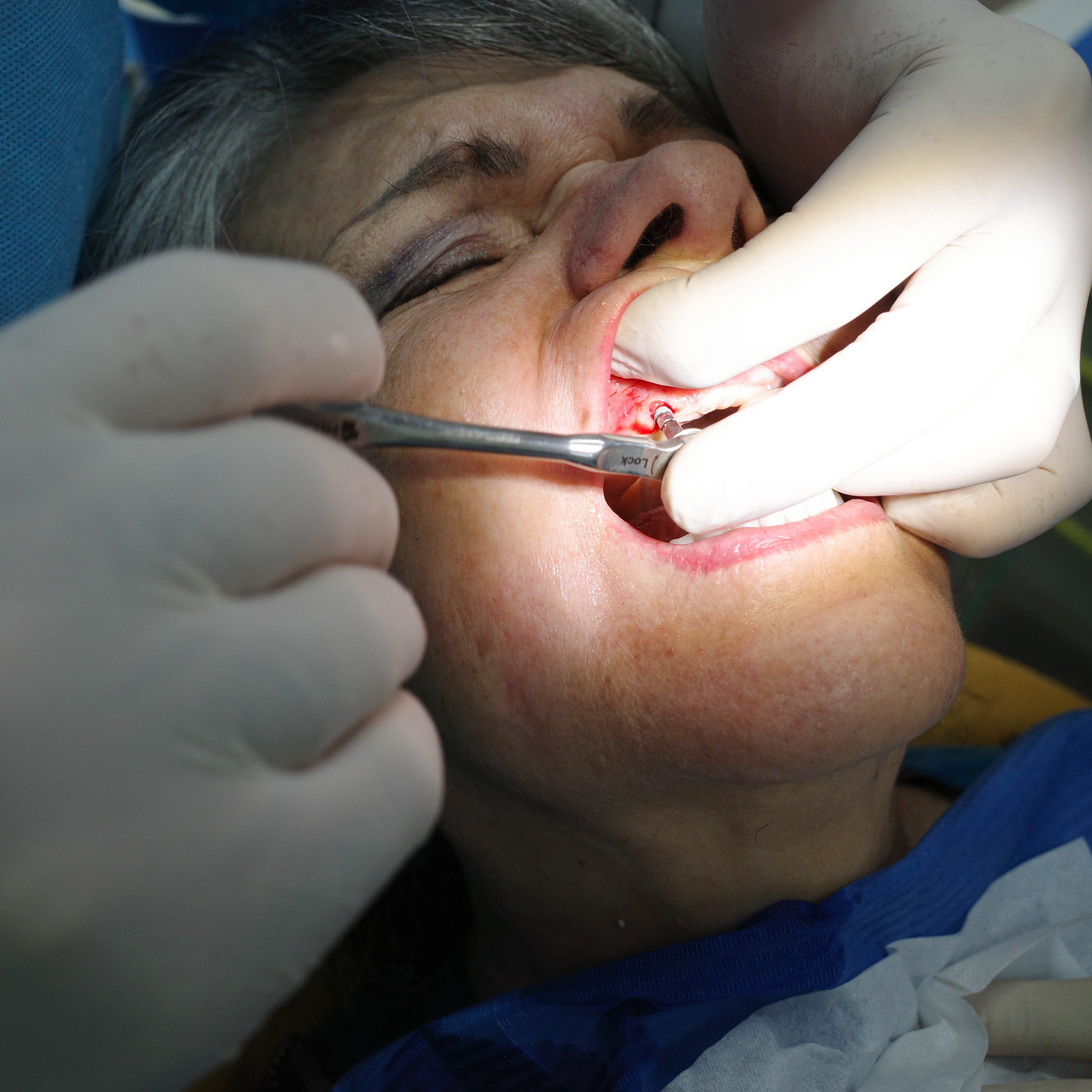 Impianti dentali in centro a Milano