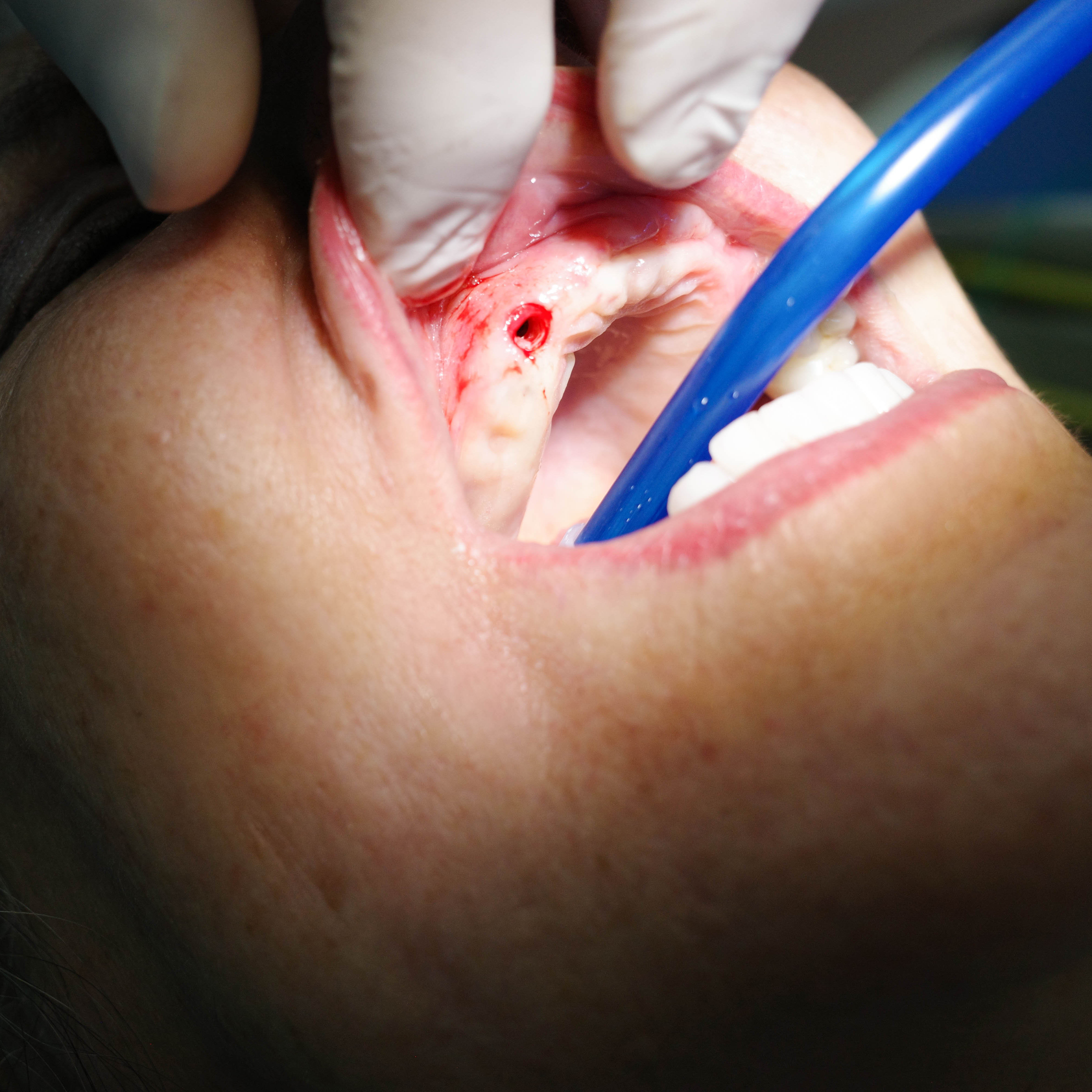 Impianti dentali in centro a Milano