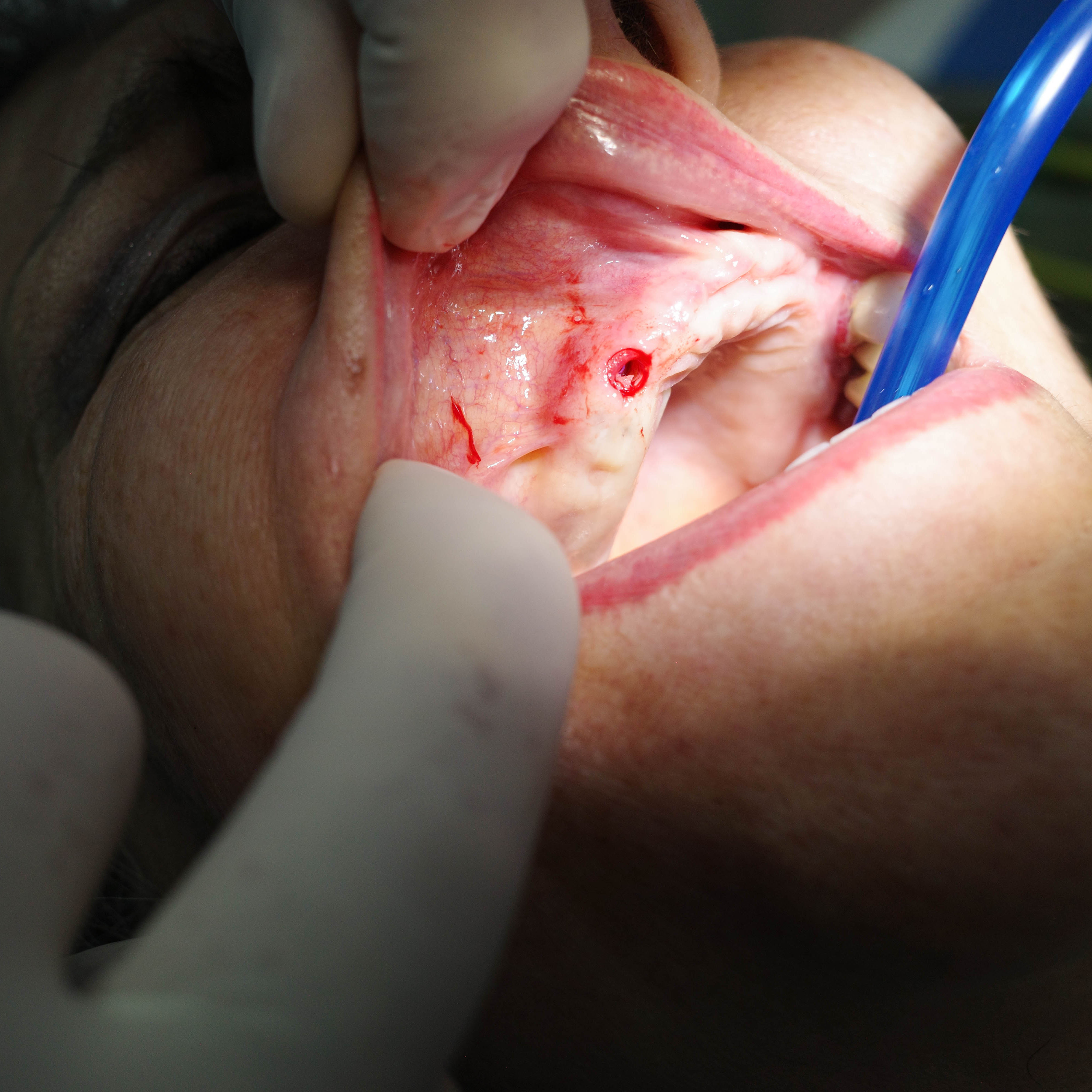 Impianti dentali in centro a Milano