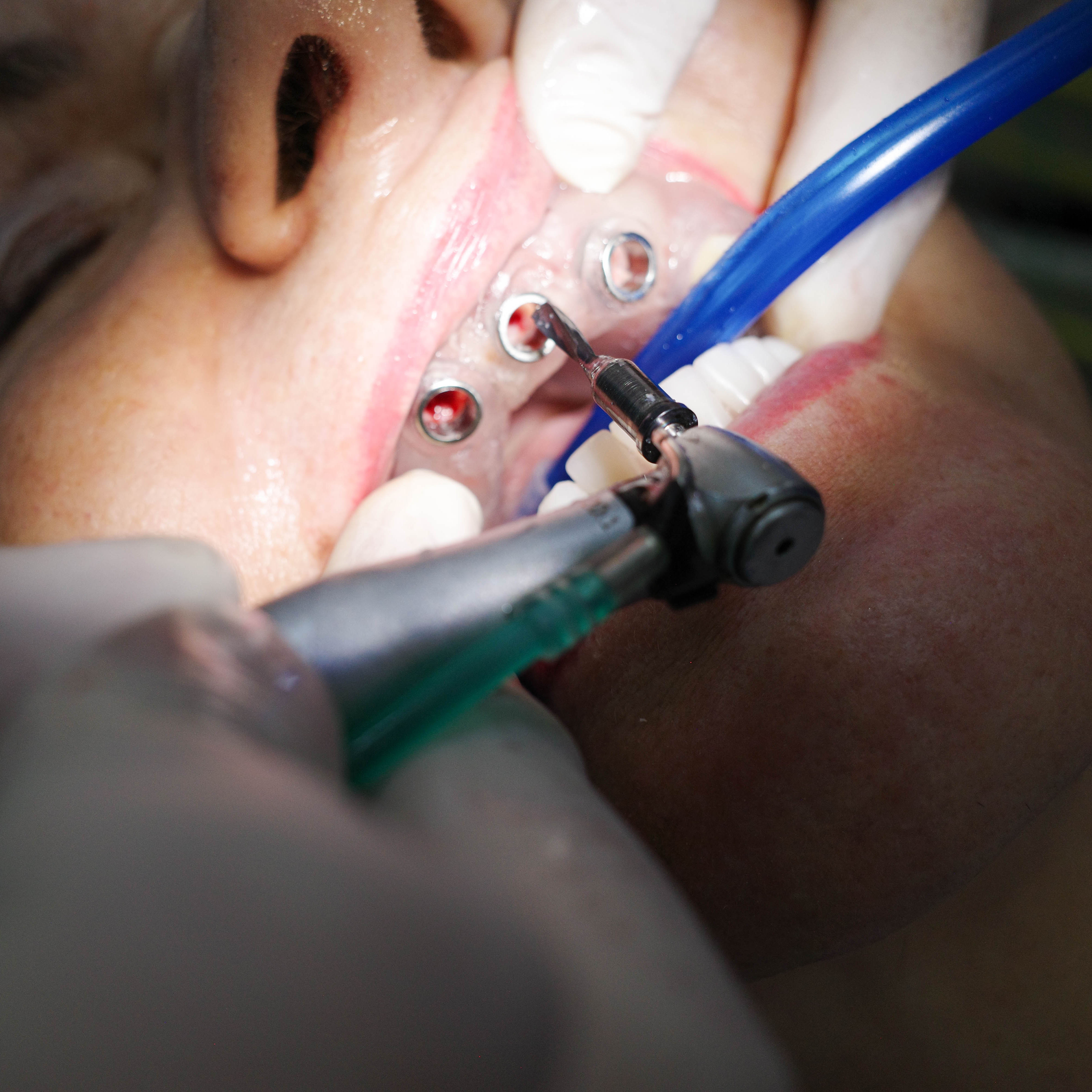 Un impianto dentale posizionato con tecnica flapless