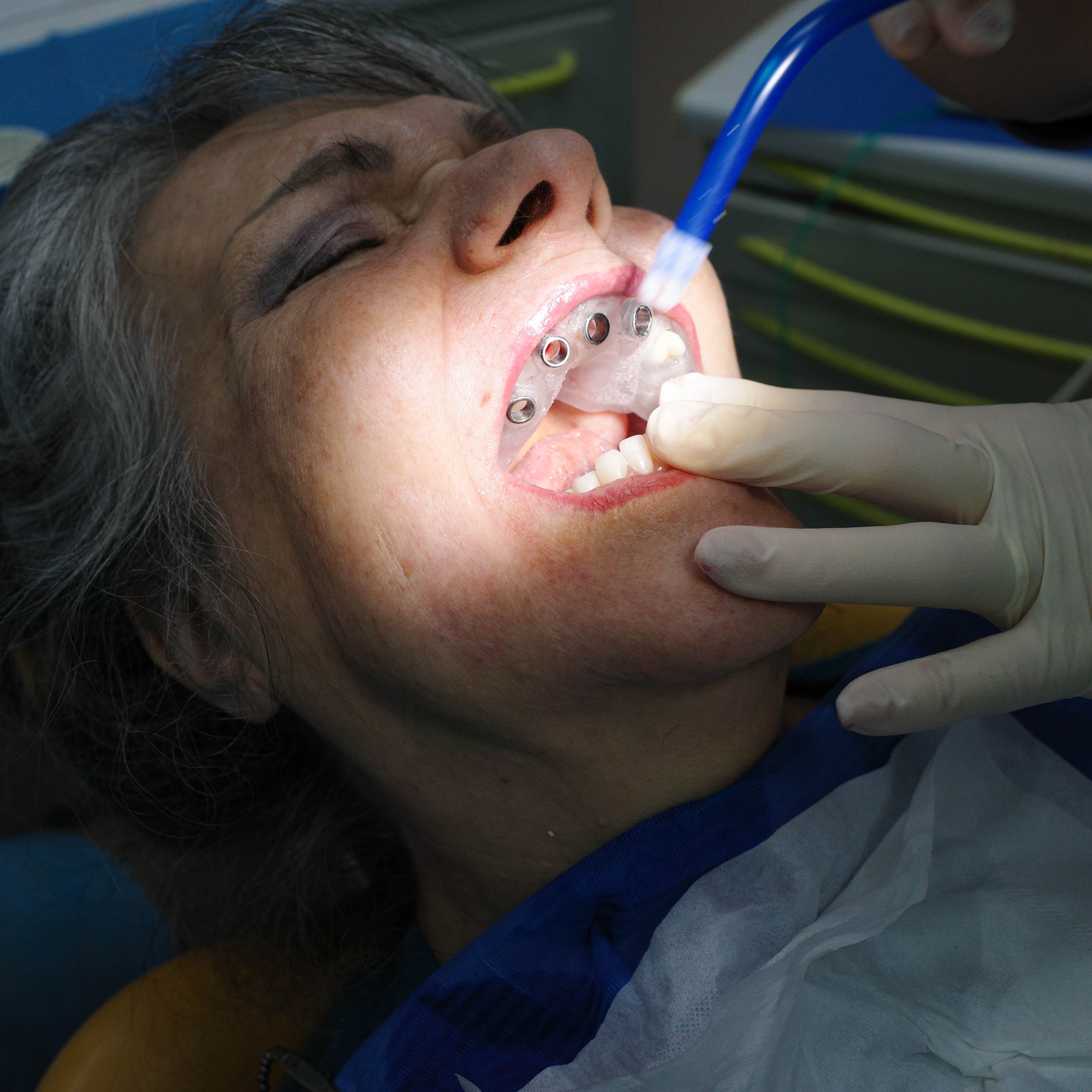 Impianti dentali in centro a Milano