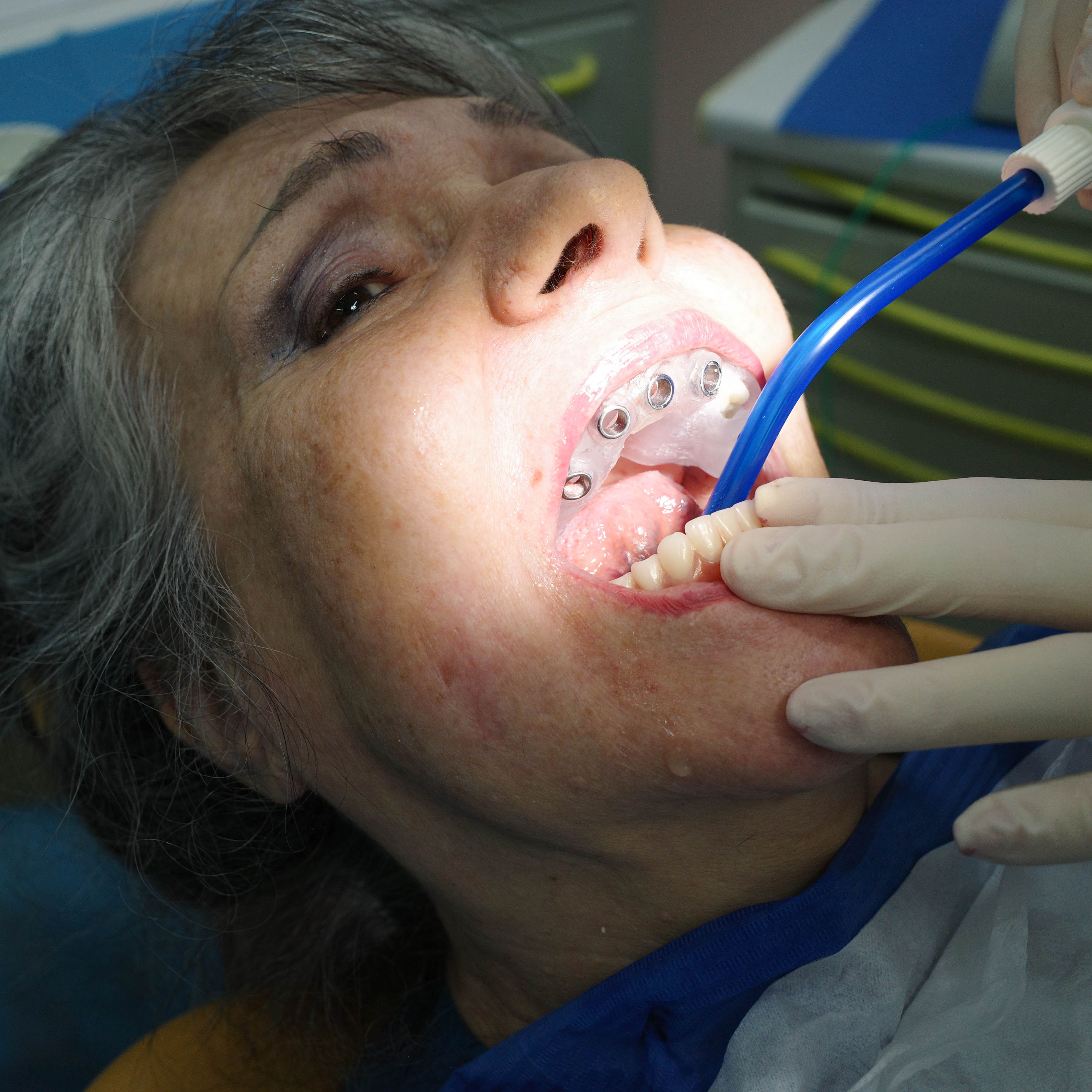 Impianti dentali in centro a Milano