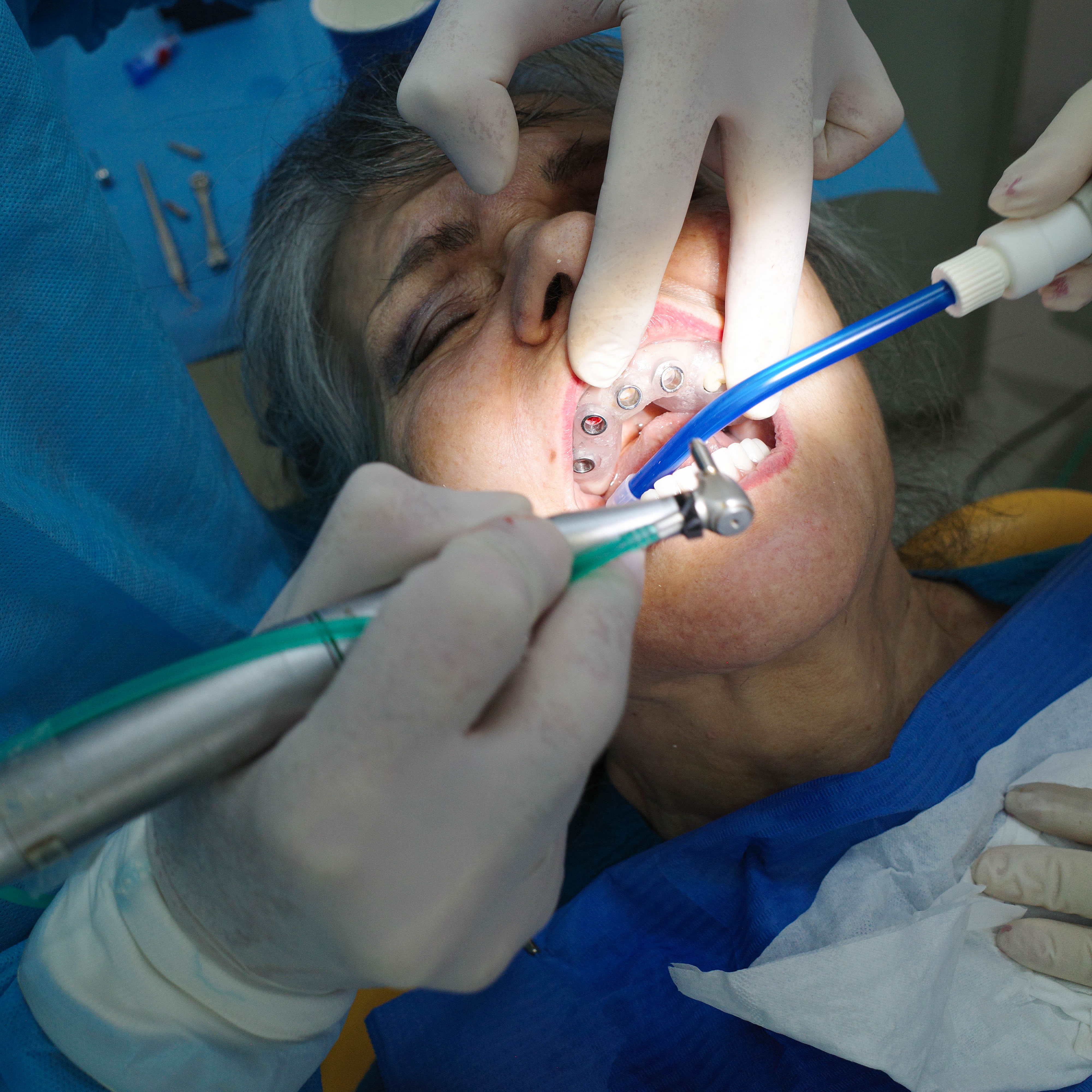 Impianti dentali in centro a Milano