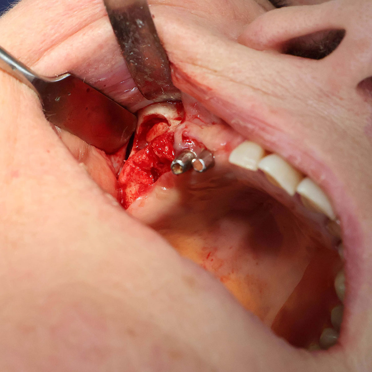 Impianti dentali in centro a Milano