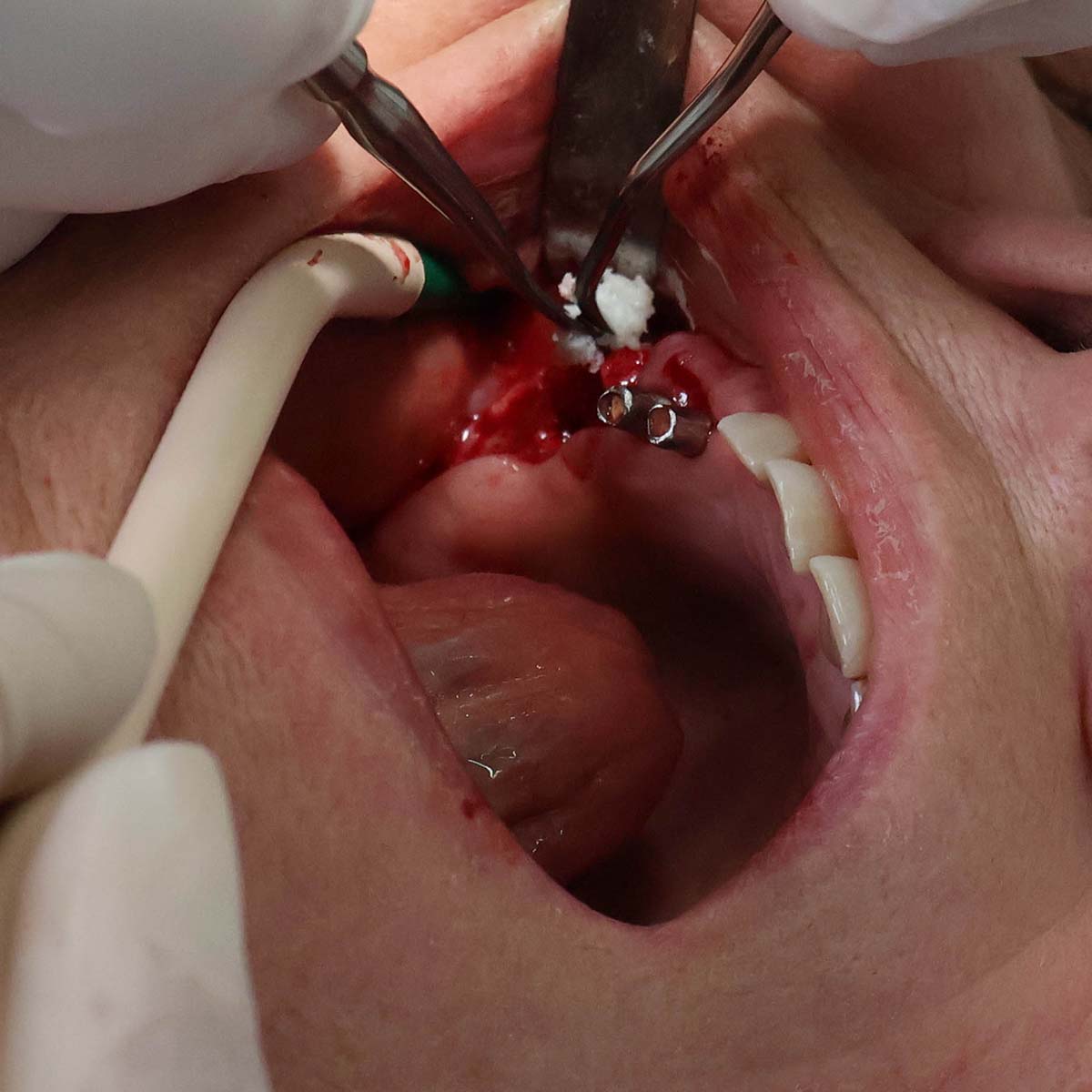 Impianti dentali in centro a Milano