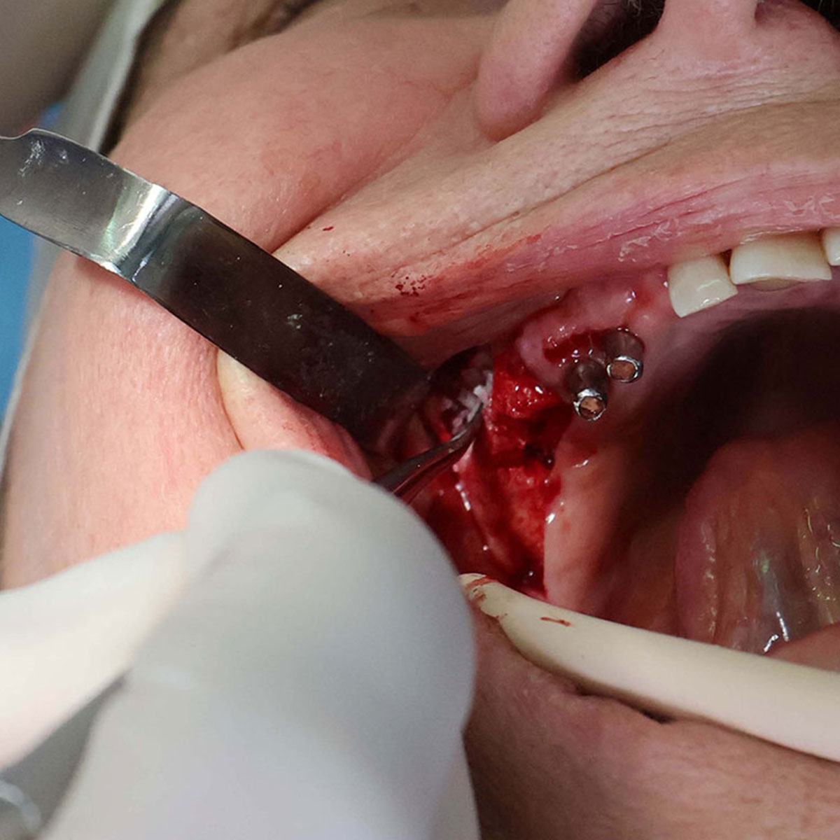 Impianti dentali in centro a Milano