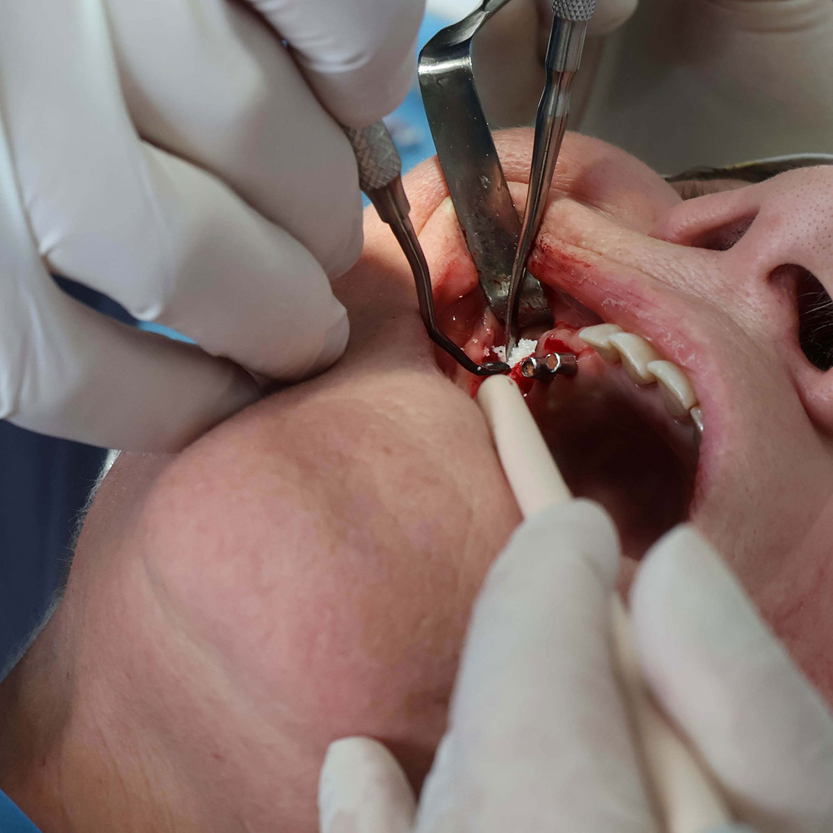 Impianti dentali in centro a Milano