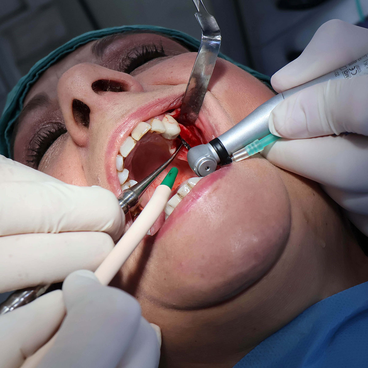 Impianti dentali in centro a Milano