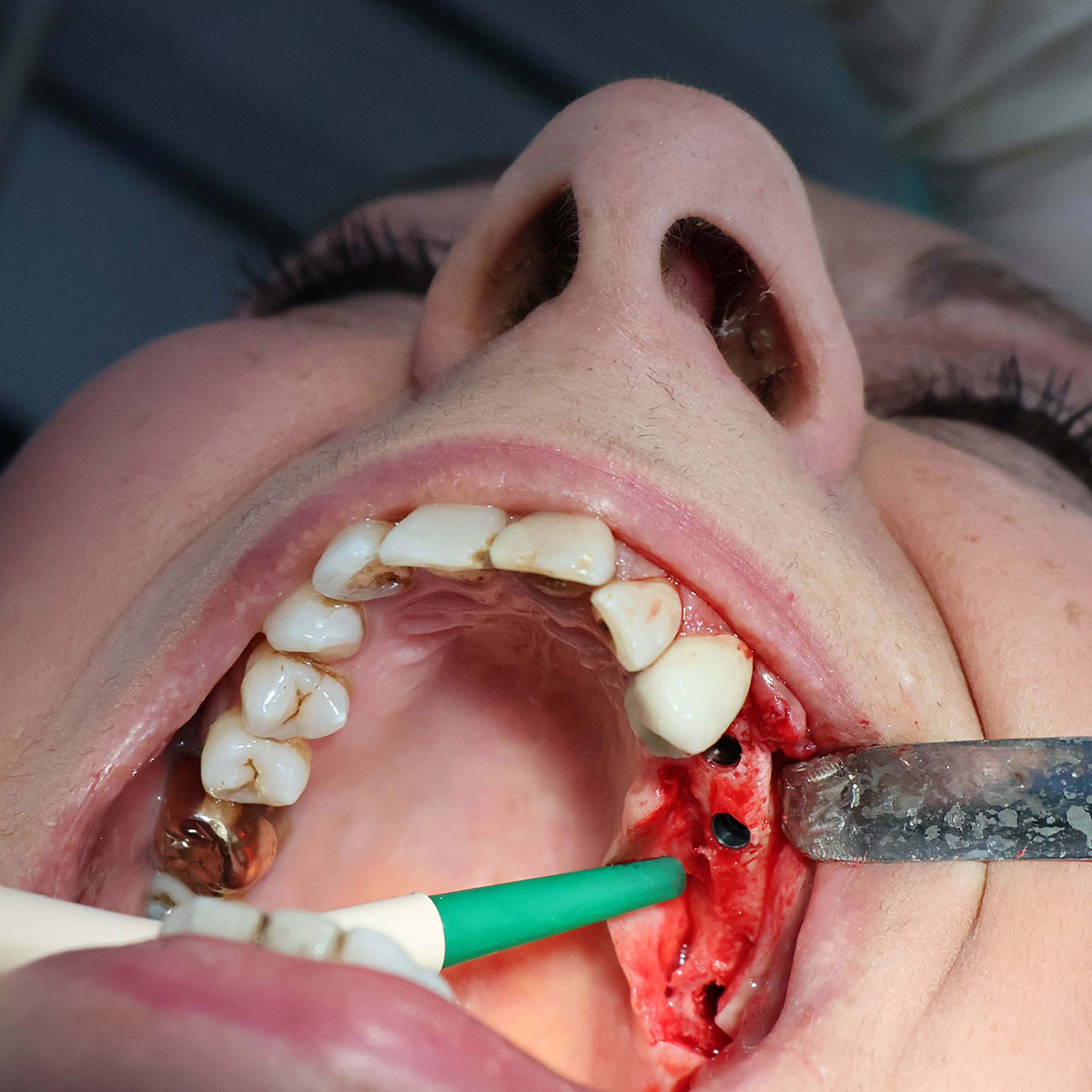 Impianti dentali in centro a Milano