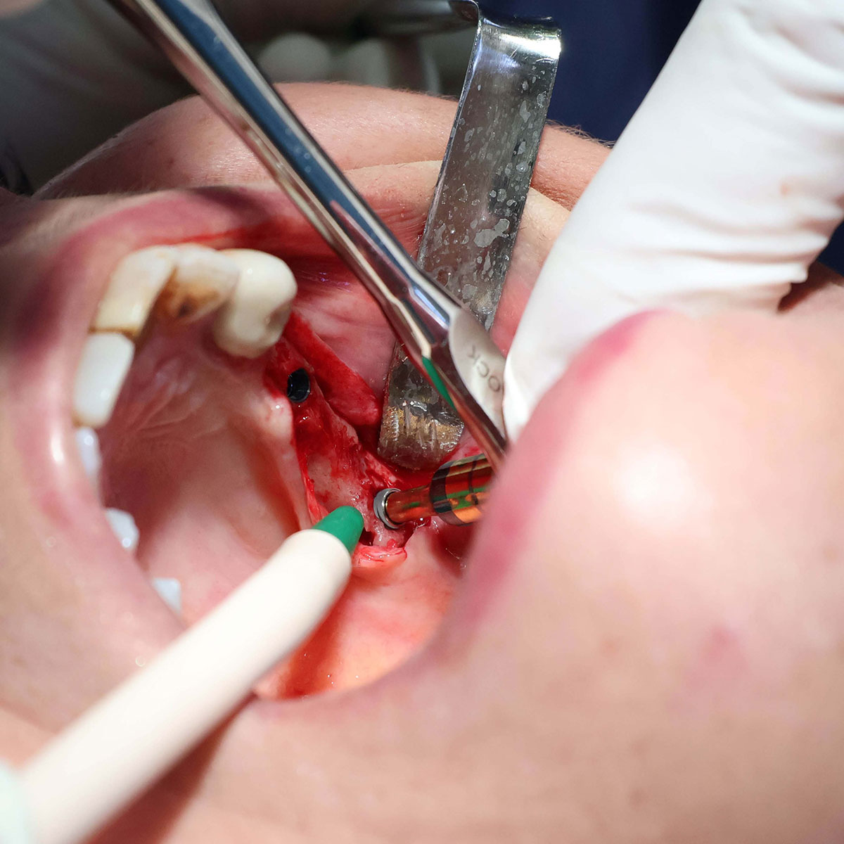 Impianti dentali in centro a Milano