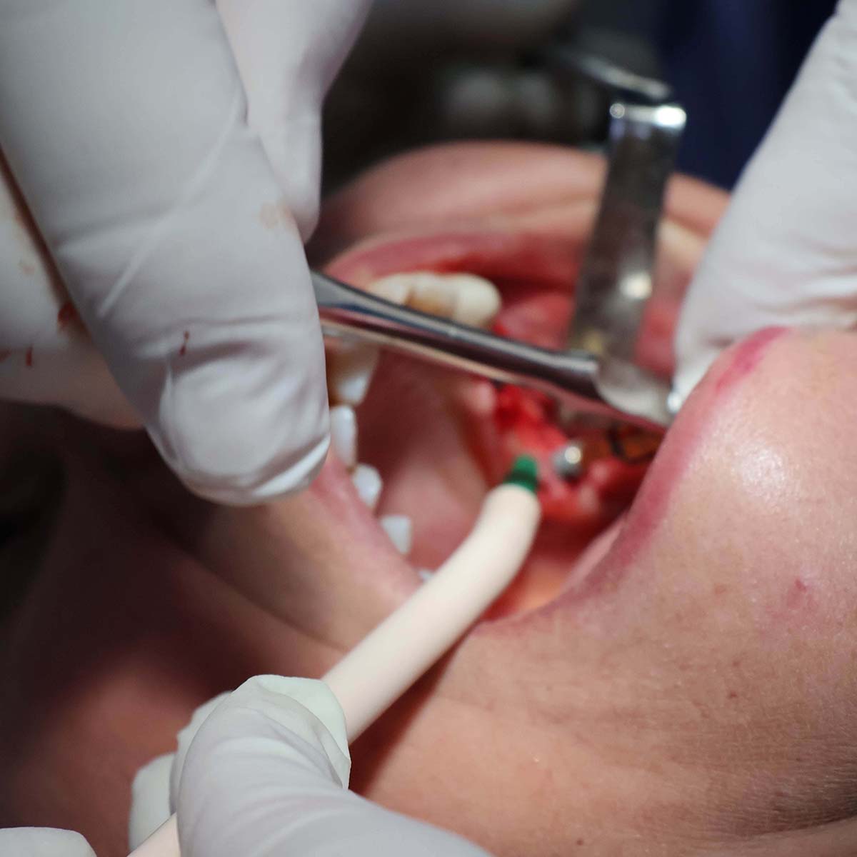 Impianti dentali in centro a Milano