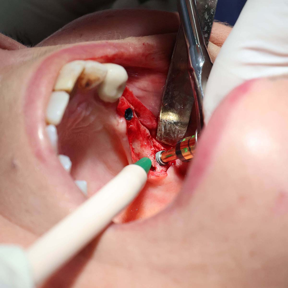 Impianti dentali in centro a Milano