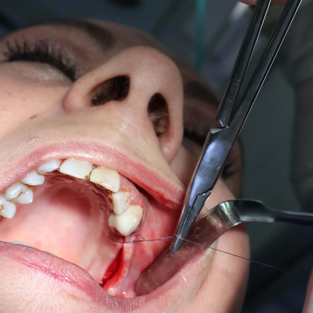 Impianti dentali in centro a Milano