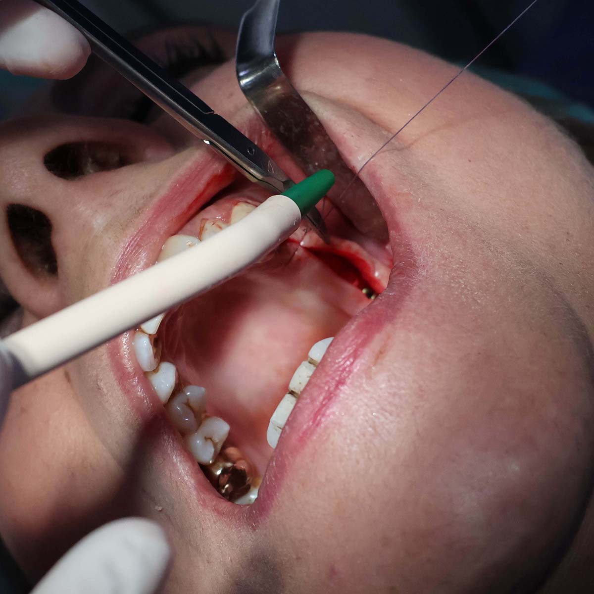 Impianti dentali in centro a Milano