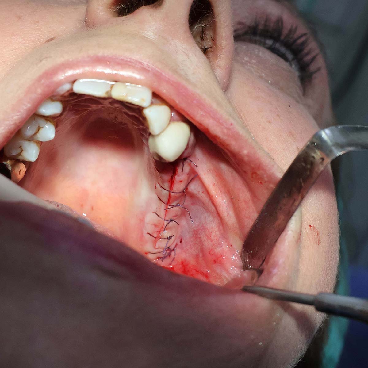 Impianti dentali in centro a Milano