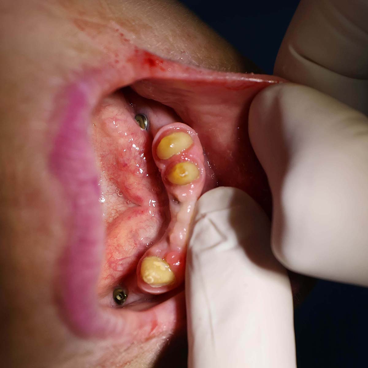 Impianti dentali in centro a Milano