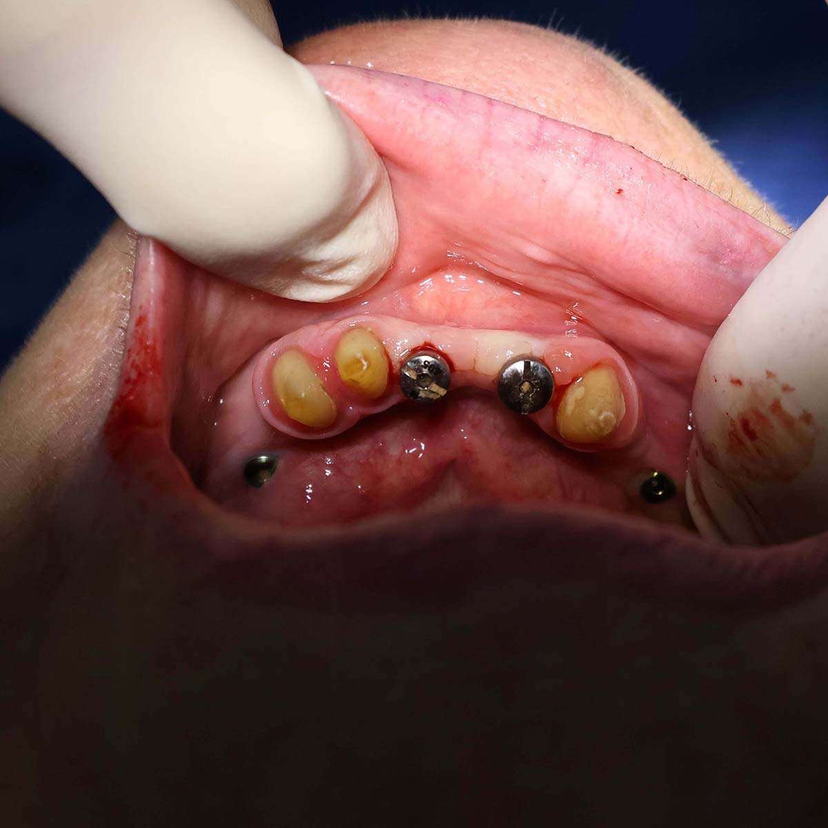 Impianti dentali in centro a Milano