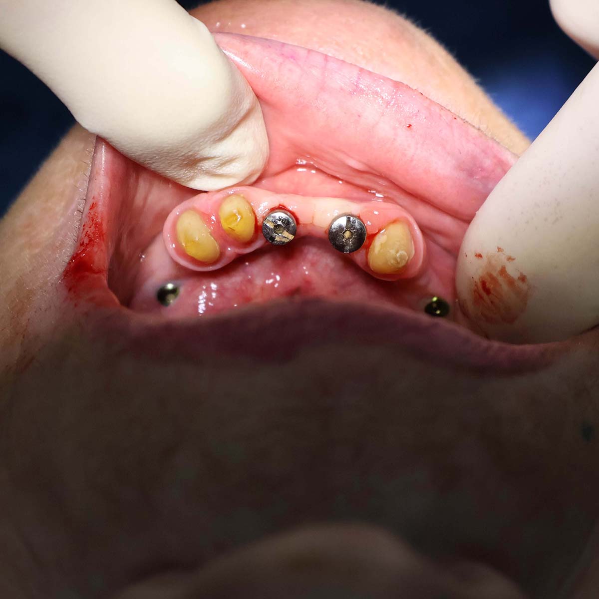 Impianti dentali in centro a Milano