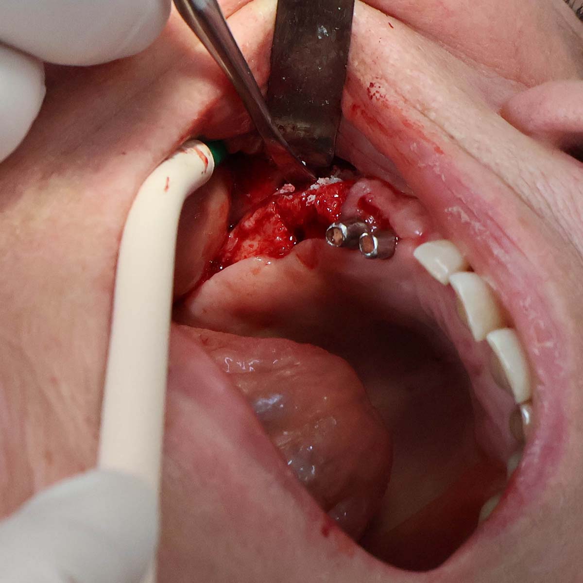 Impianti dentali in centro a Milano