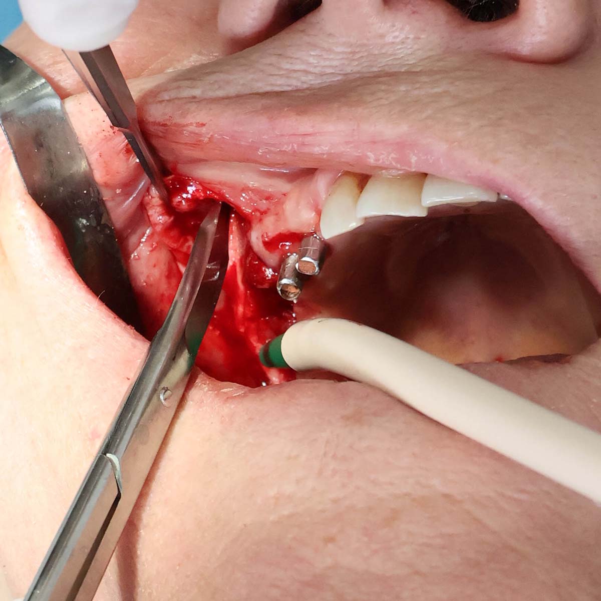 Impianti dentali in centro a Milano