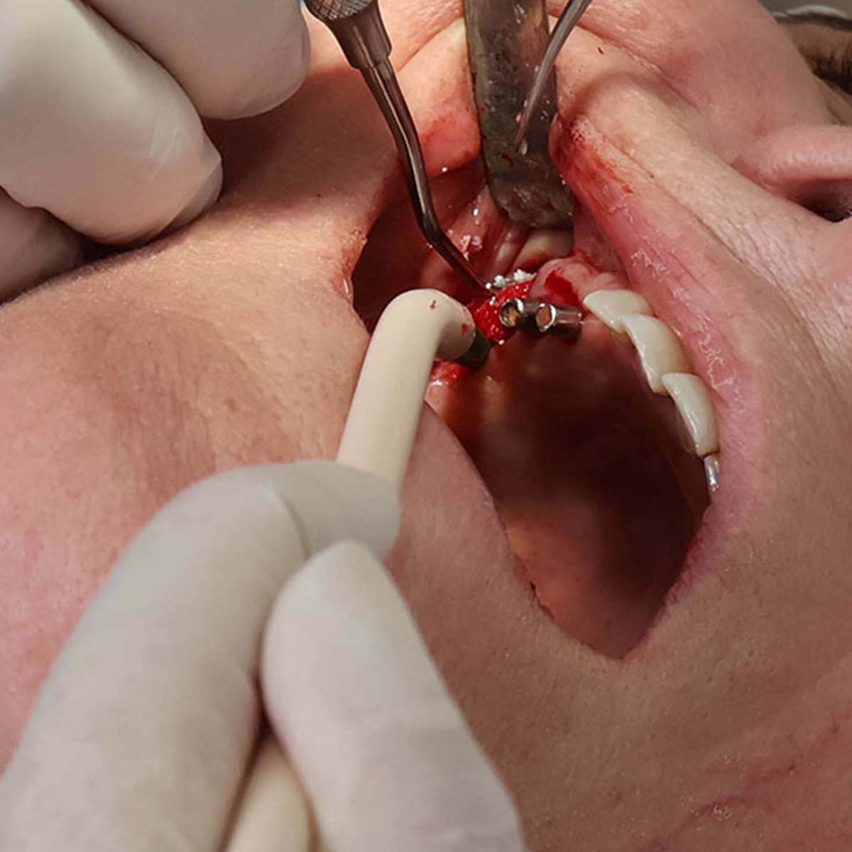 Impianti dentali in centro a Milano