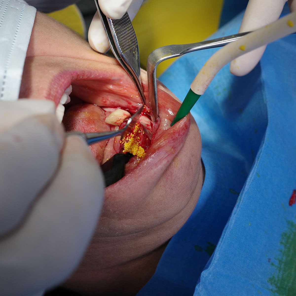 Laser odontoiatrico per la parodontite