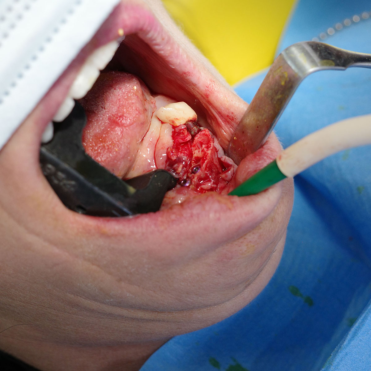 Impianti dentali in centro a Milano