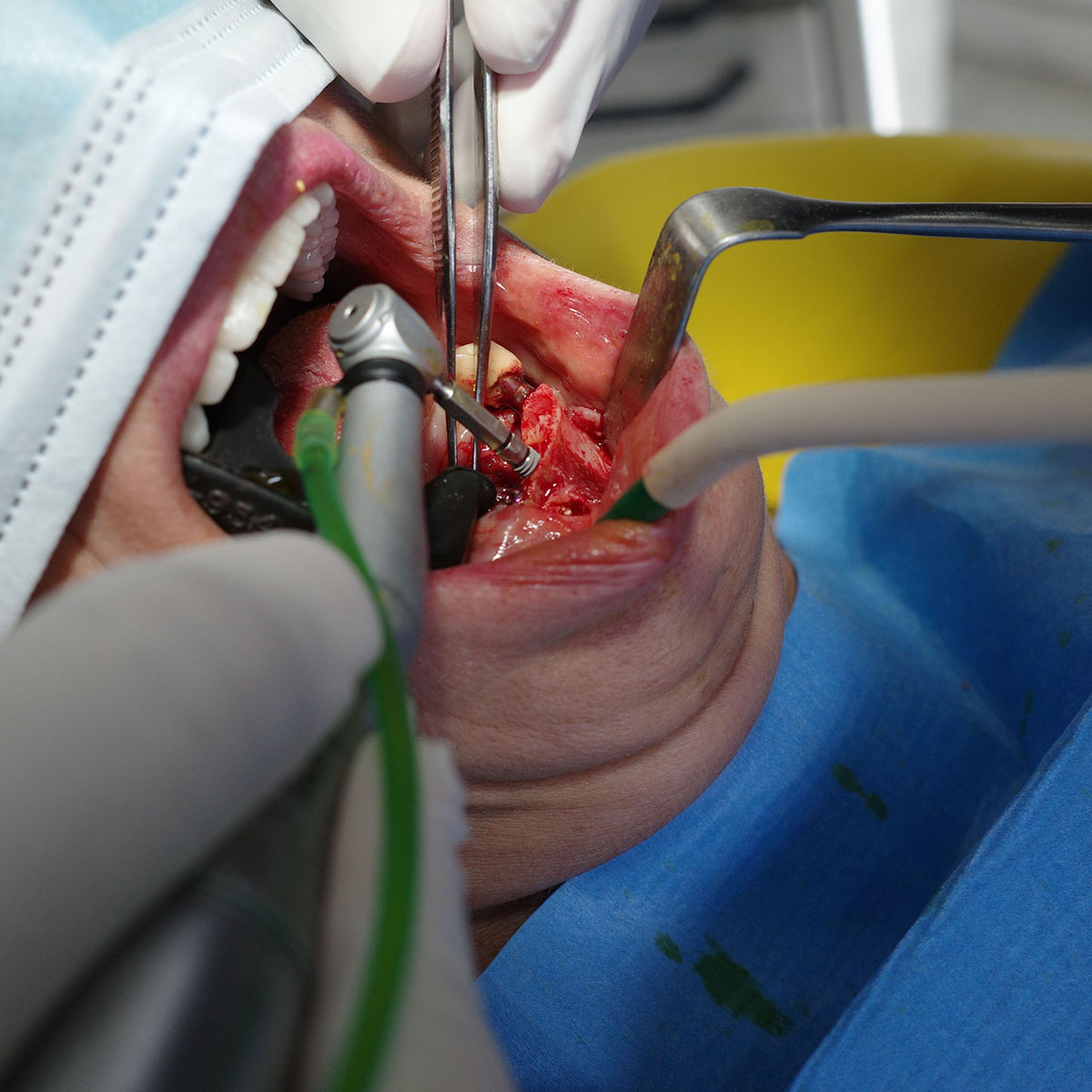 Impianti dentali in centro a Milano