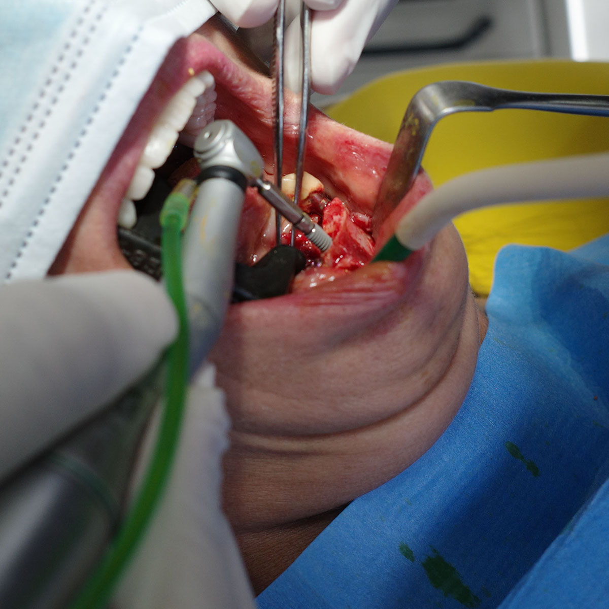 Impianti dentali in centro a Milano