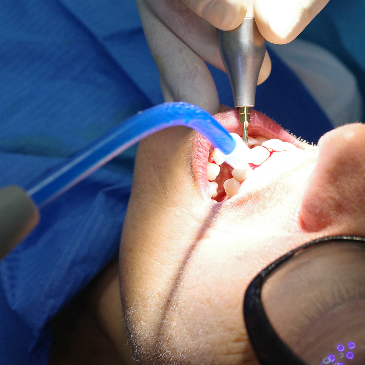 Impianti dentali in centro a Milano