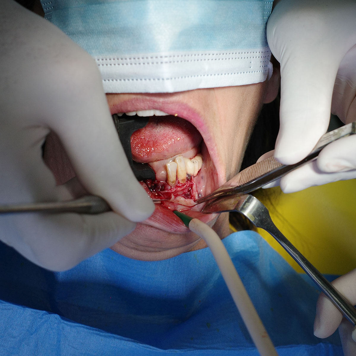 Impianti dentali in centro a Milano