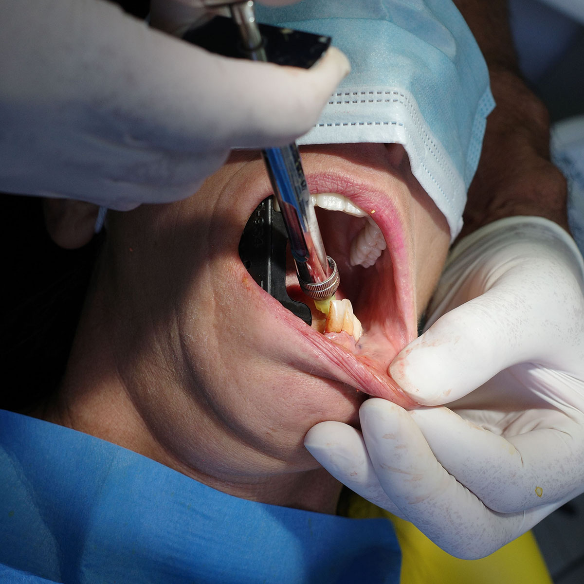 Impianti dentali in centro a Milano