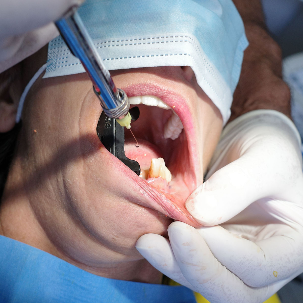 Impianti dentali in centro a Milano