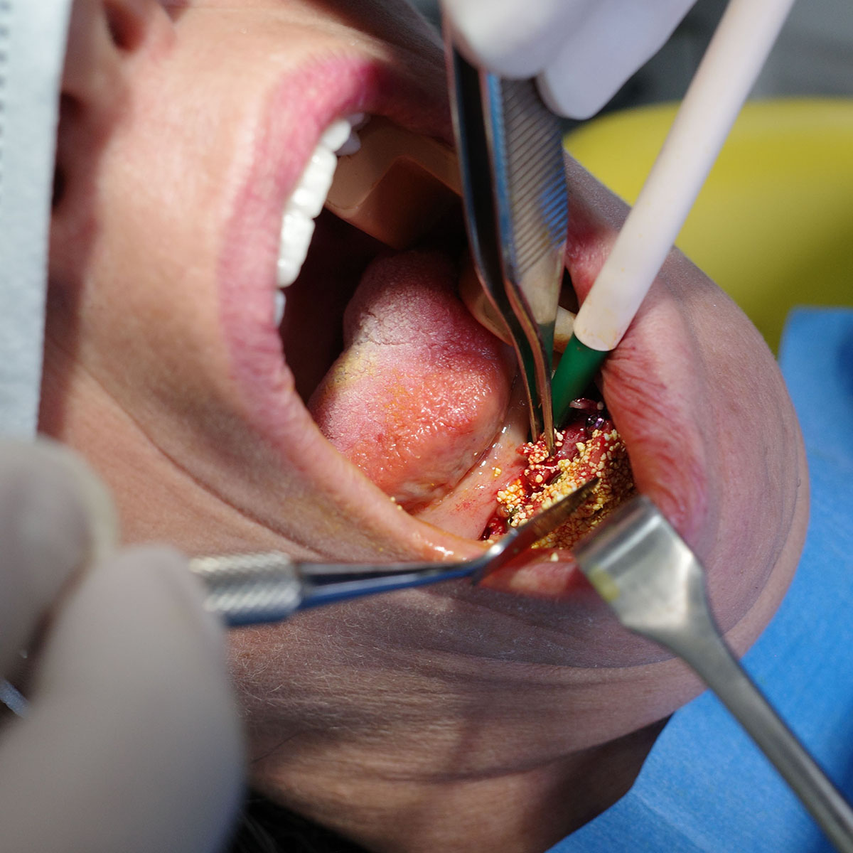 Impianti dentali in centro a Milano