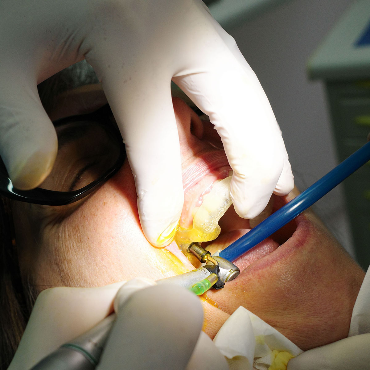 Impianti dentali in centro a Milano