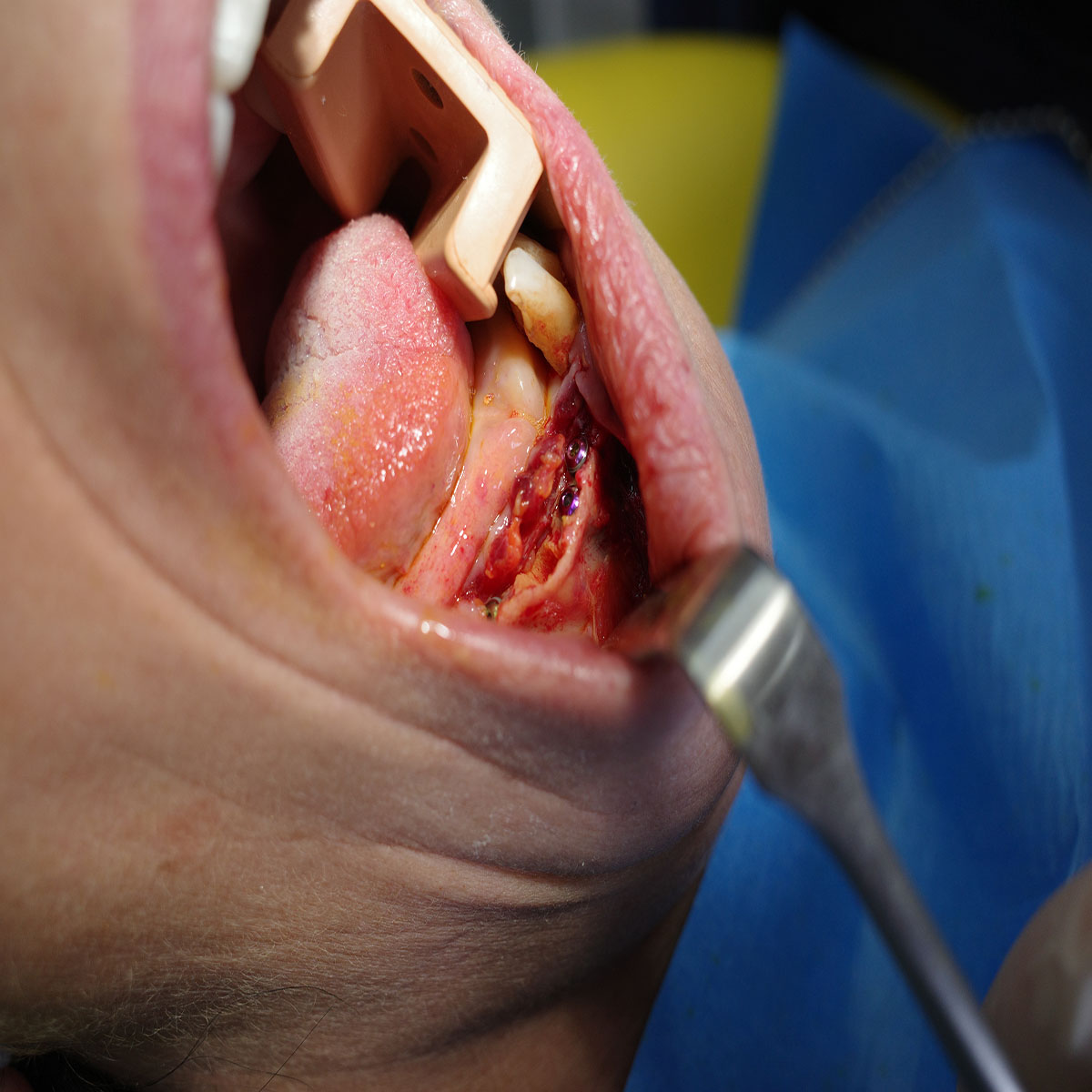 Impianti dentali in centro a Milano