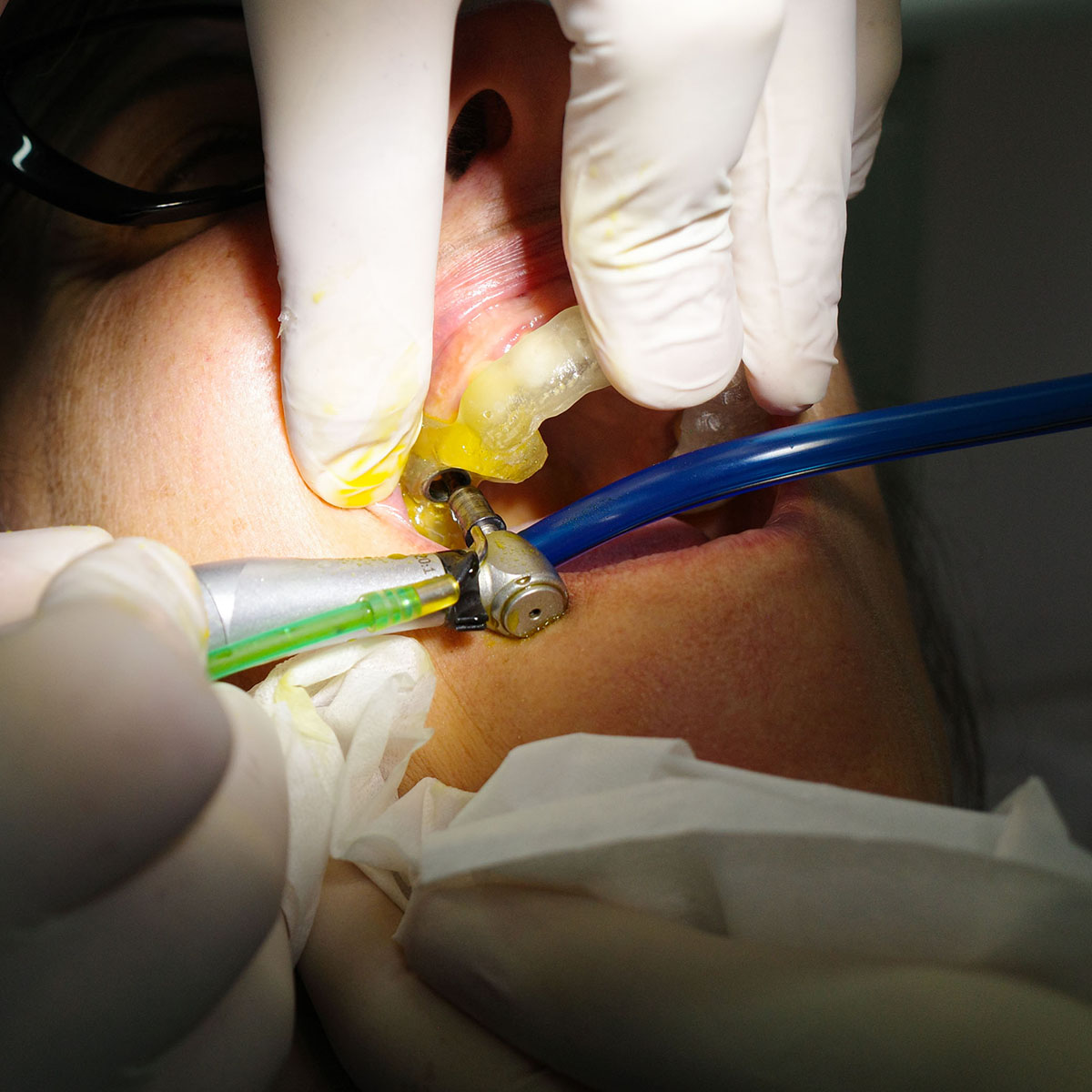 Impianti dentali senza dolore a Milano