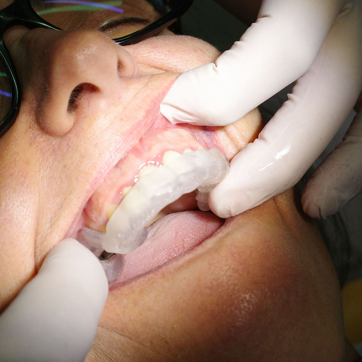 Impianti dentali in centro a Milano