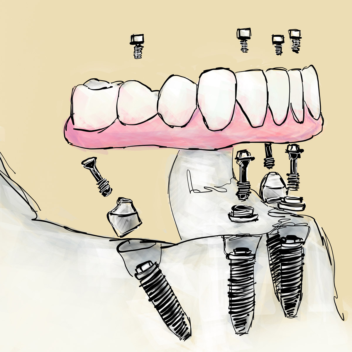 Impianti dentali in centro a Milano
