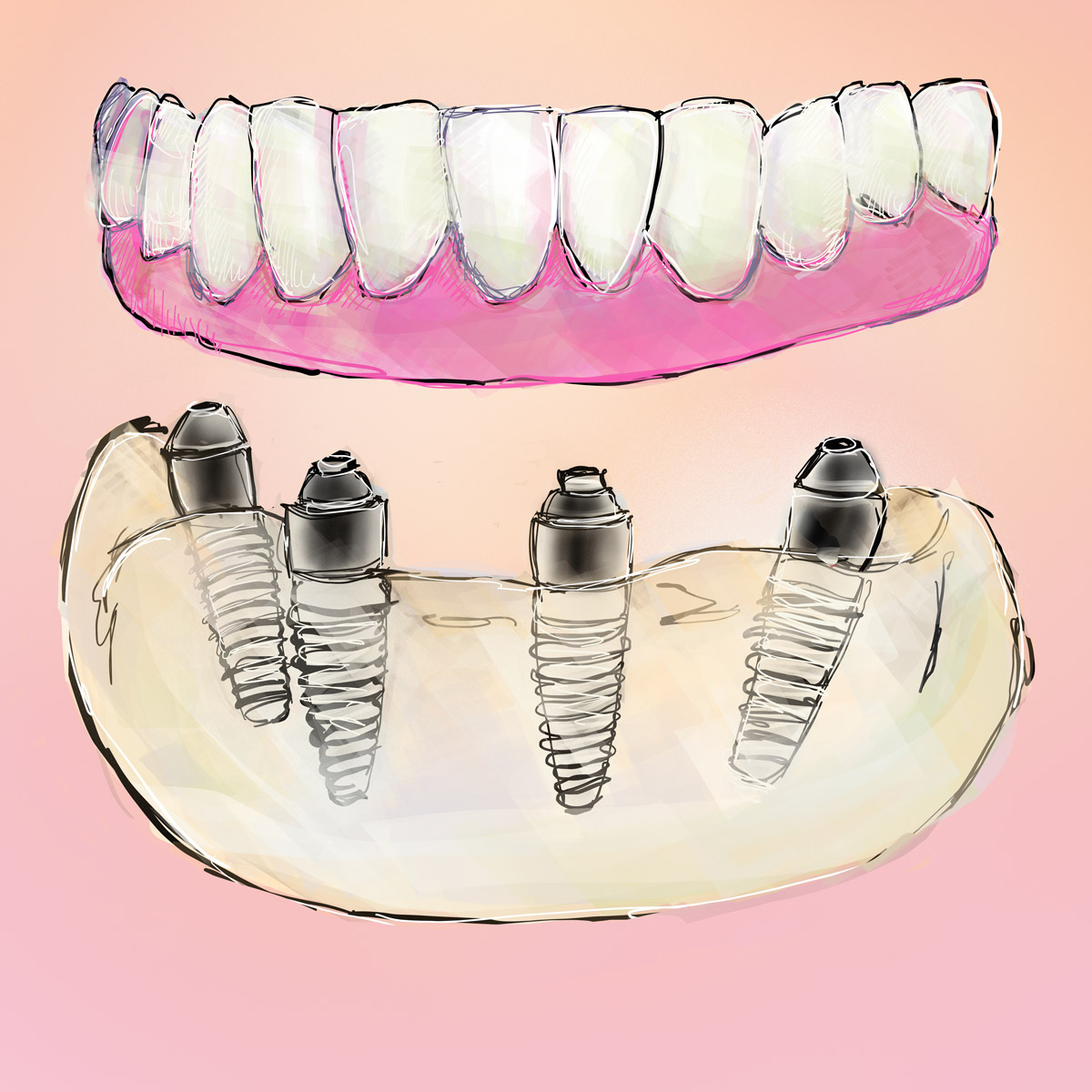 Impianti dentali in centro a Milano