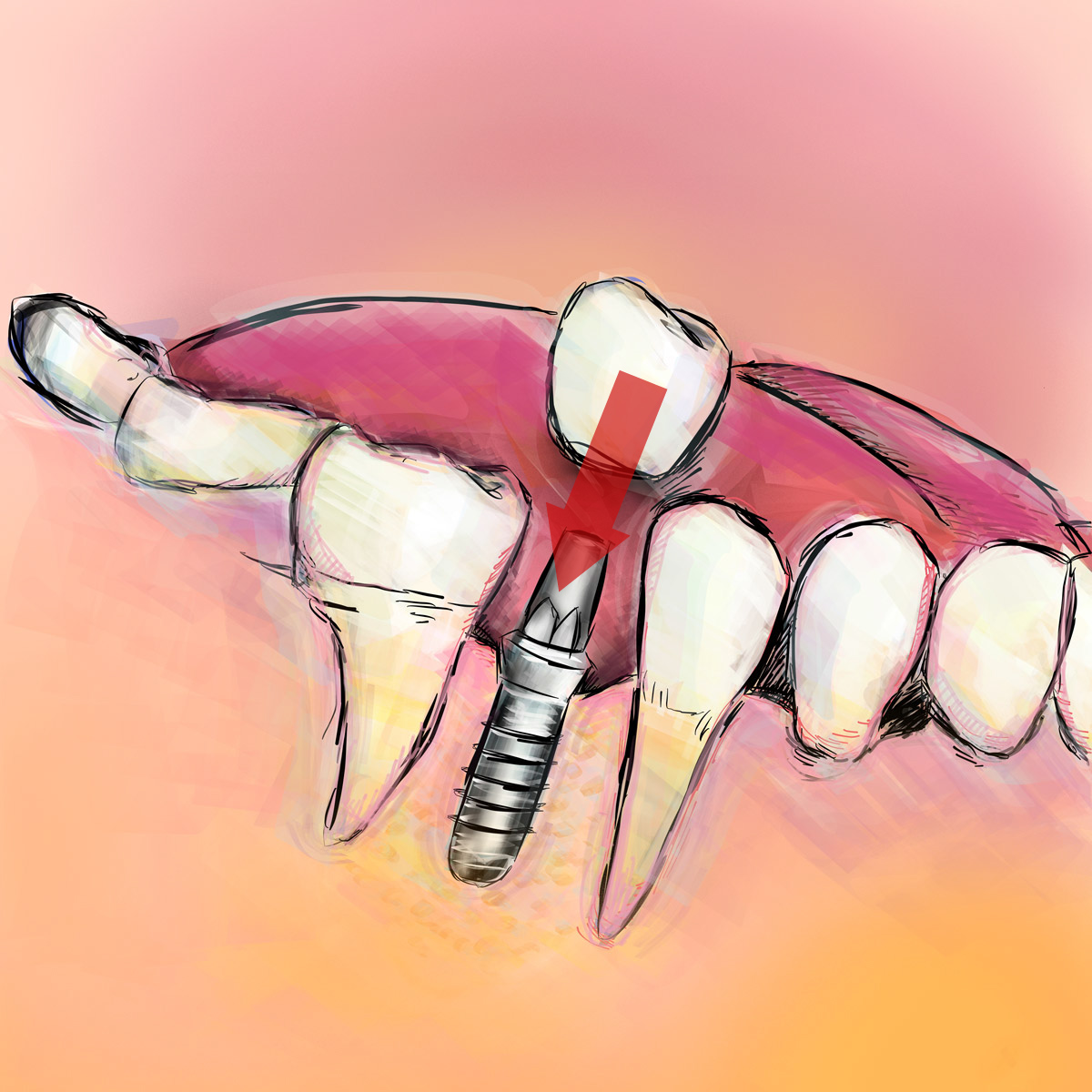 Impianti dentali in centro a Milano