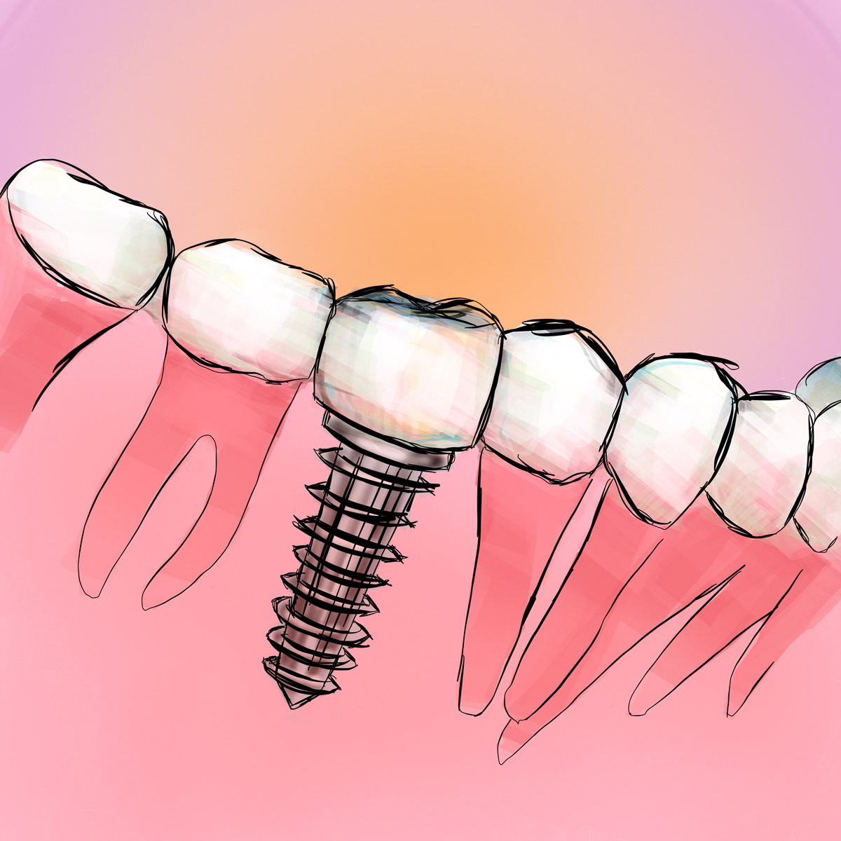 Impianti dentali in centro a Milano