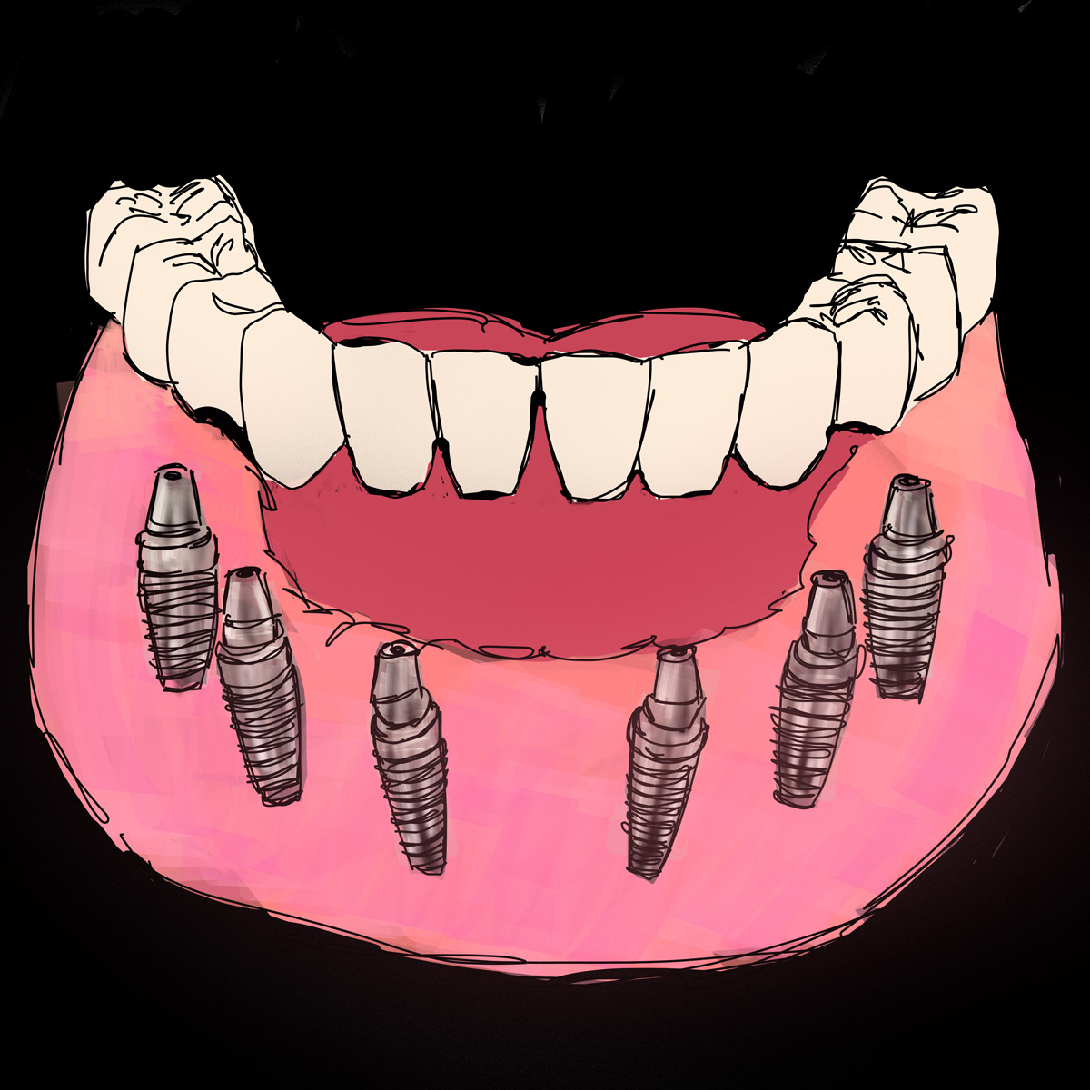 Impianti dentali in centro a Milano