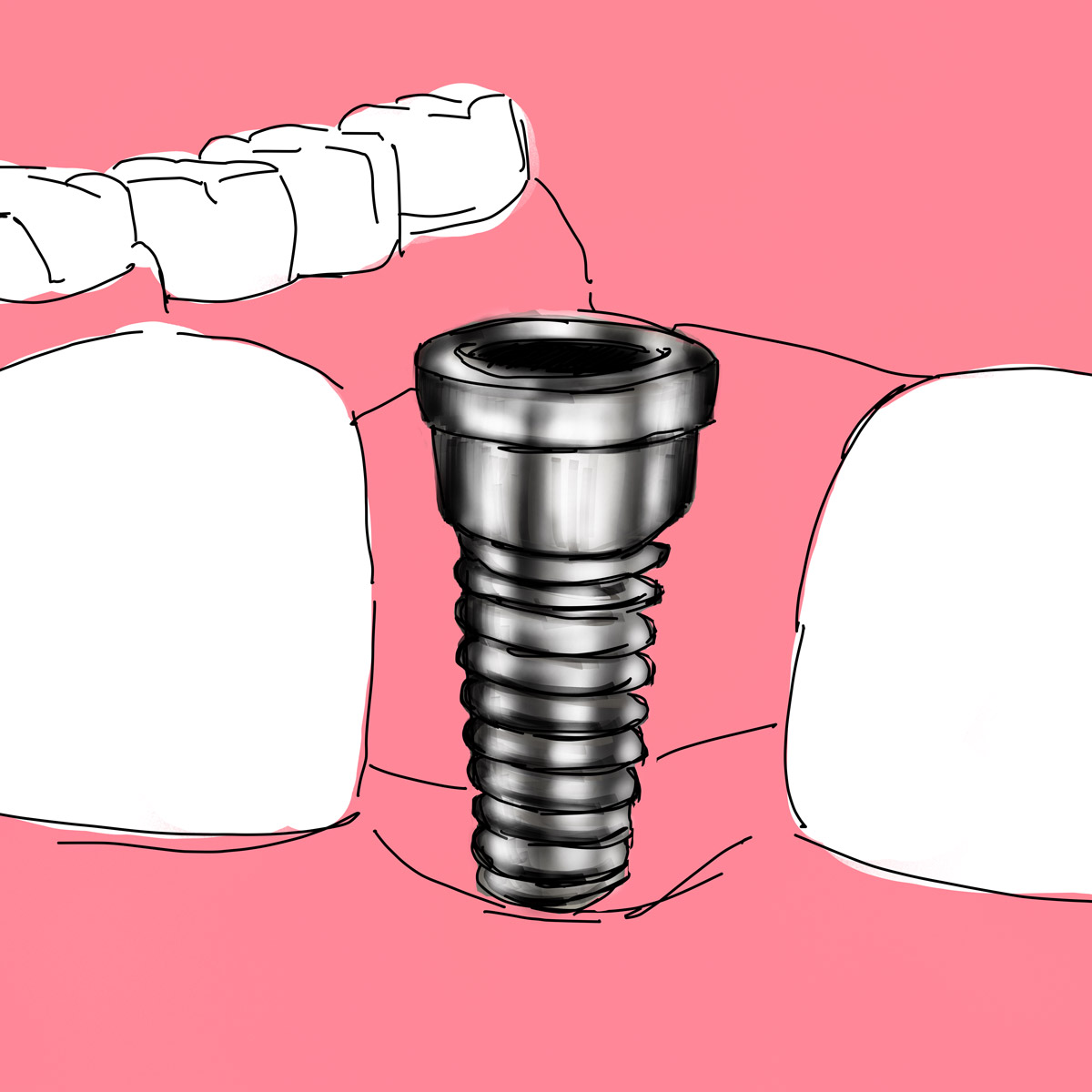 Impianti dentali in centro a Milano