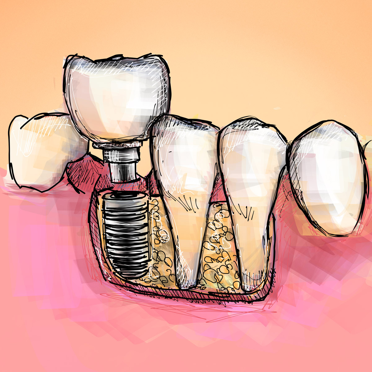 Impianti dentali in centro a Milano