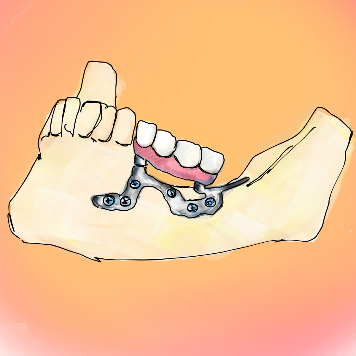 Impianti dentali in centro a Milano