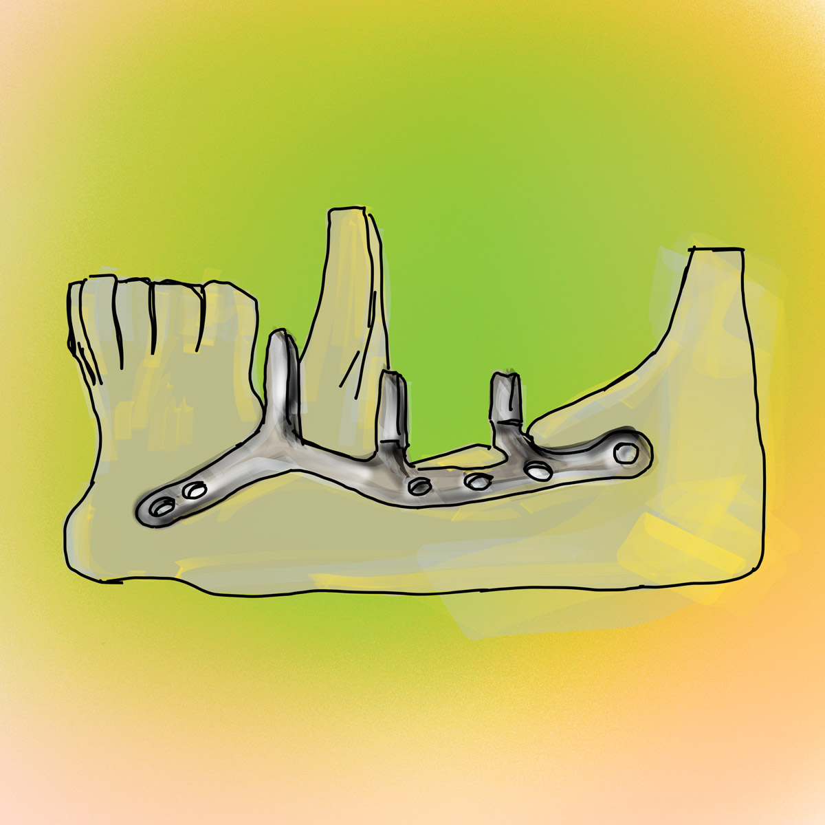 Impianti dentali in centro a Milano